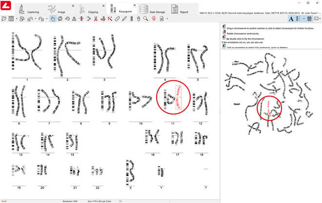 Chromosome enhancement in karyogram and metaphase image