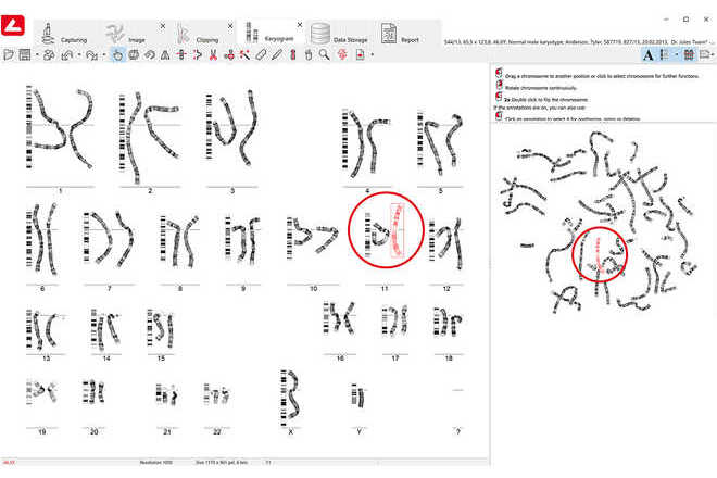 Chromosome enhancement in karyogram and metaphase image